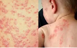 10 lưu ý không thể bỏ qua để chung sống với bệnh vảy nến