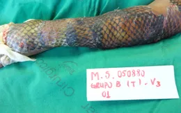 Thử nghiệm trị bỏng bằng da cá rô phi