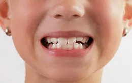 Tật nghiến răng khi ngủ ảnh hưởng sức khỏe như thế nào?