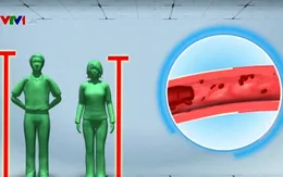 Người cao dễ bị tắc mạch máu