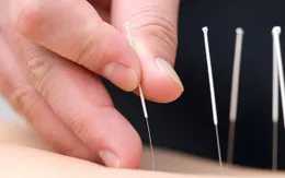 Châm cứu có hiệu quả trong chữa trị hội chứng ống cổ tay