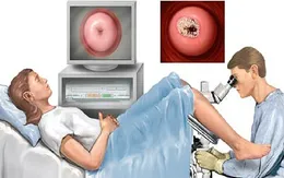 Dấu hiệu sớm của bệnh ung thư cổ tử cung