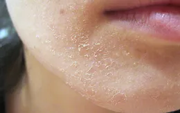 Lạm dụng corticoid, da bạn phải đối diện vấn đề gì?