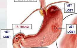 Phổ biến bệnh ung thư dạ dày xuất phát từ viêm loét dạ dày
