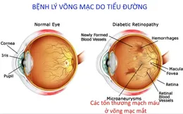 Tìm hiểu bệnh võng mạc do đái tháo đường