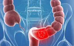 Trò chuyện cùng Dr.ANH: Viêm đại tràng (phần 2)