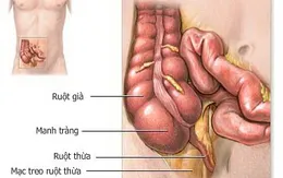 Bệnh viêm đại tràng co thắt dễ tái phát