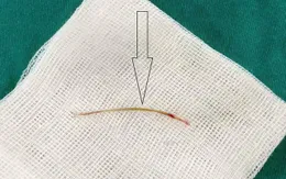 Đau bụng âm ỉ cả tuần, phát hiện do xương cá đâm thủng ruột