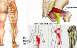Các biện pháp chữa đau lưng, đau thần kinh tọa do thoát vị đĩa đệm