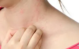 Dị ứng thực phẩm ở người lớn: Không nên xem nhẹ