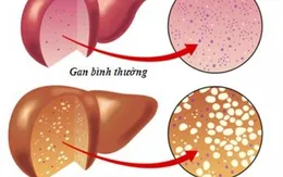 Biểu hiện của gan nhiễm mỡ qua từng giai đoạn