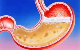 Một số dấu hiệu "tố" bạn có vấn đề về dạ dày