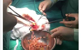Kinh hoàng ổ giun lớn gây tắc ruột bé 3 tuổi