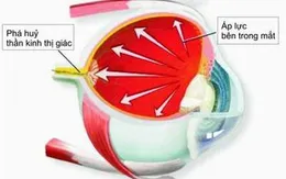 Dấu hiệu nhận biết và phương pháp điều trị bệnh glocom