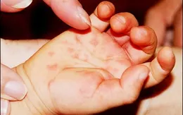 Dấu hiệu điển hình trẻ mắc tay chân miệng