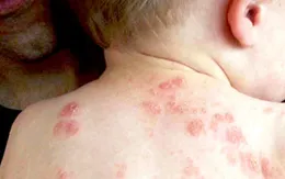Bị côn trùng độc tấn công - Chớ coi thường!