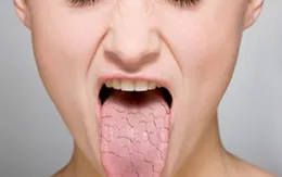 Khô miệng có thể nghiêm trọng hơn bạn nghĩ