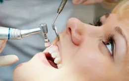 Có nên lấy cao răng thường xuyên?