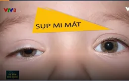 Cảnh giác với hậu quả của chứng sụp mi mắt