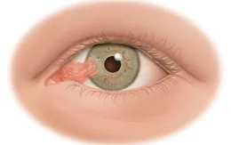 Bệnh mộng mắt và phương pháp điều trị