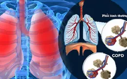 Những bệnh lý nguy hại về phổi