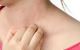 Cách phòng tránh dị ứng thời tiết mùa Thu