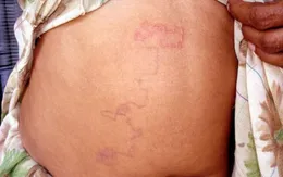Cha mẹ cần làm gì để giun không hút máu trẻ gây suy kiệt sức khỏe?