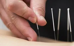 Điều trị cho trẻ tự kỷ bằng châm cứu, cấy chỉ