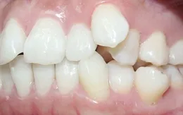 Cách điều trị răng xô lệch tận gốc