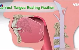 Nguyên nhân răng mọc xô lệch