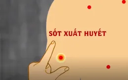 Dấu hiệu mắc sốt xuất huyết bạn có thể tự nhận biết