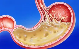 Những thực phẩm rất tốt cho người đau dạ dày