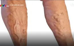 Tìm hiểu về căn bệnh suy giãn tĩnh mạch