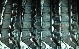 “Giải thoát” khỏi căn bệnh thoát vị đĩa đệm mà không phải phẫu thuật
