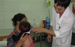 Cảnh báo nguy cơ bội nhiễm thủy đậu từ người lớn sang trẻ em