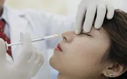 Các biến chứng nguy hểm của chất làm đầy filler