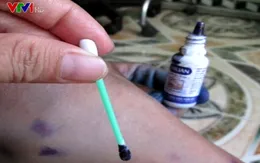 Vệ sinh đúng cách cho trẻ bị thủy đậu