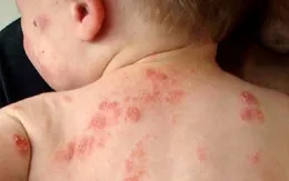 Phòng tránh viêm da ở trẻ