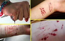Tự làm đau bản thân là hành vi tự sát