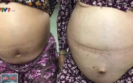 TP.HCM: Bóc tách thành công khối u 20kg cho bệnh nhân 80 tuổi