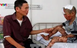 Bé trai 9 tuổi mắc vảy cá bẩm sinh hiếm gặp