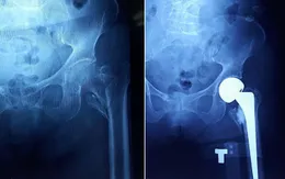 Cụ bà 102 tuổi được thay khớp háng nhân tạo thành công