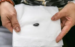 Ho suốt 4 năm vì hạt sapôchê mắc kẹt trong phế quản