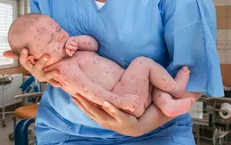 Báo động số ca bệnh sởi tăng nhanh chóng tại Israel