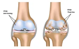 Thói quen xấu gây thoái hóa khớp
