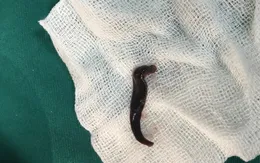 Gắp con đỉa dài 5cm trong mũi người phụ nữ