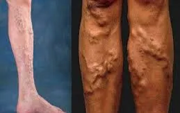 Những điều cần biết về bệnh suy tĩnh mạch chi dưới