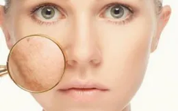 Thuốc nội tiết điều trị nám, sự thật là gì?