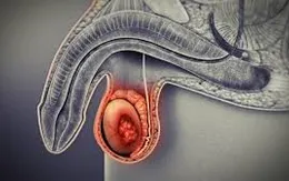 Nam giới và triệu chứng u nang bìu tinh hoàn