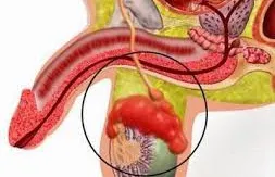 Nguyên nhân gây viêm mào tinh hoàn ở nam giới